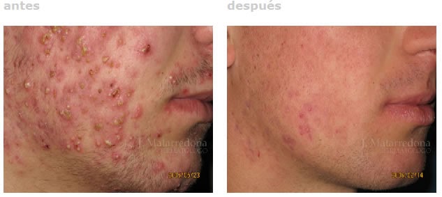 La crema de las manchas de pigmento y las manchas de los granos